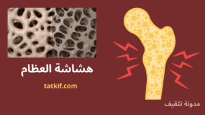 Read more about the article مرض هشاشة العظام : الأسباب الخفية، الأعراض والعلاجات