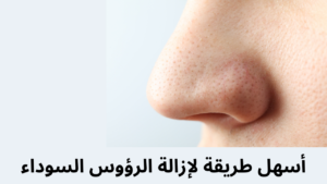 Read more about the article أسباب ظهور الرؤوس السوداء في الوجه و طرق علاجها